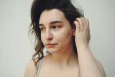 dermatologista-da-dicas-para-acabar-com-a-acne-e-para-manter-a-pele-do-rosto-saudavel
