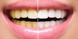 dentista-explica-erro-mais-comum-na-escovacao-que-pode-deixar-seus-dentes-mais-amarelos