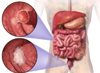 os-sinais-precoces-de-cancer-de-intestino-que-aparecem-2-anos-antes-do-diagnostico